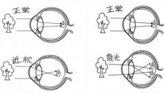 周进:看东西自带光晕滤镜(近视or散光