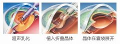 宁波博视眼科院长俞存:白内障久拖不